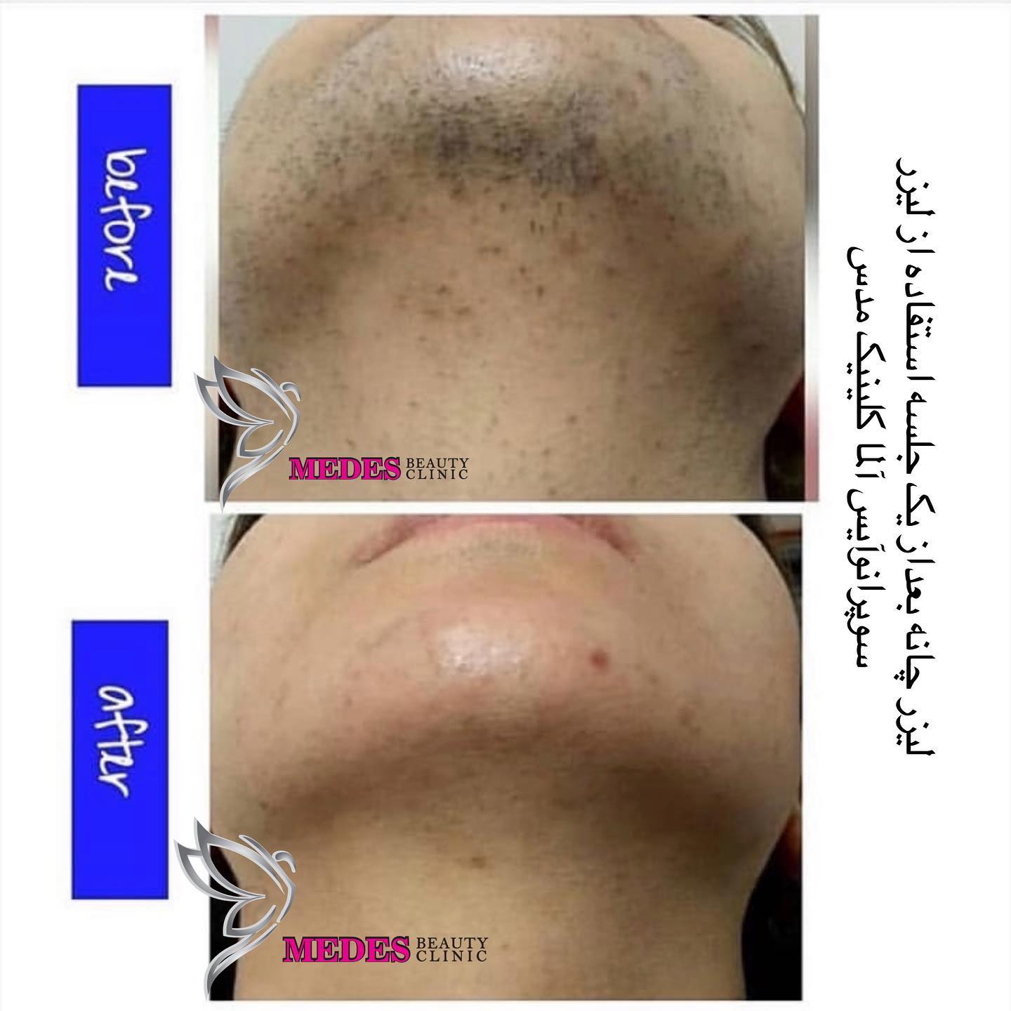 گالری لیزر مو زائد